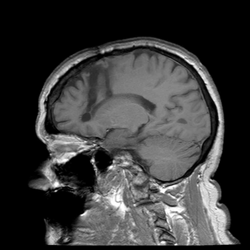 Rezonans magnetyczny czaszki pacjenta u którego wykonano kilkadziesiąt lat wcześniej lobotomię (Frank Gaillard/CC BY-SA 3.0).