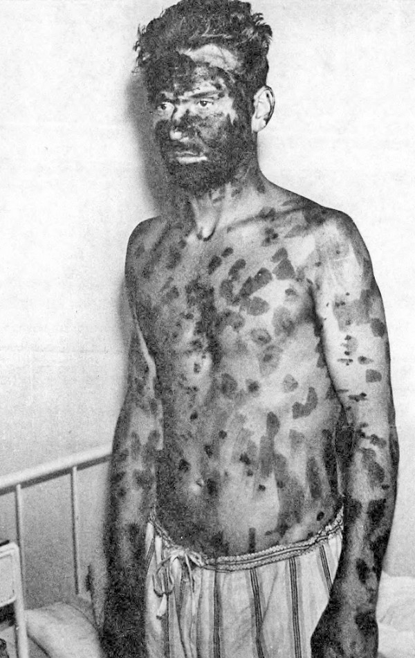 Jeden z wrocławskich pacjentów, którzy zarazili się czarną ospą. jego rany zostały posmarowane środkiem odkażającym (domena publiczna).