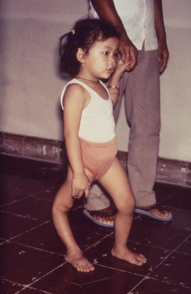 Dziewczynka dotknięta wywoływaną przez wirusa polio chorobą Heinego-Medina (domena publiczna).