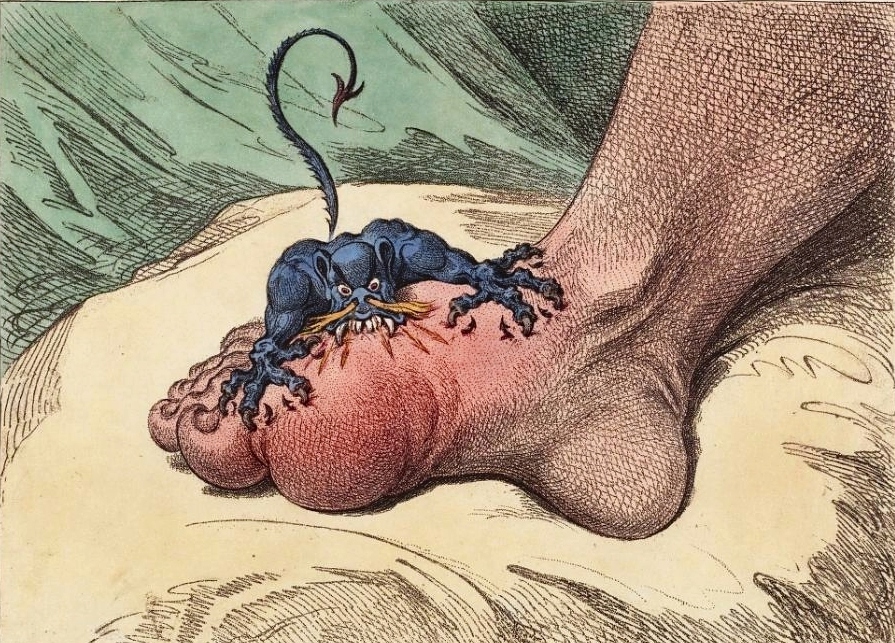 Rysunek z końca XVIII wieku przedstawiający karykaturalnie ból związany z atakiem podagry (James Gillray/domena publiczna).