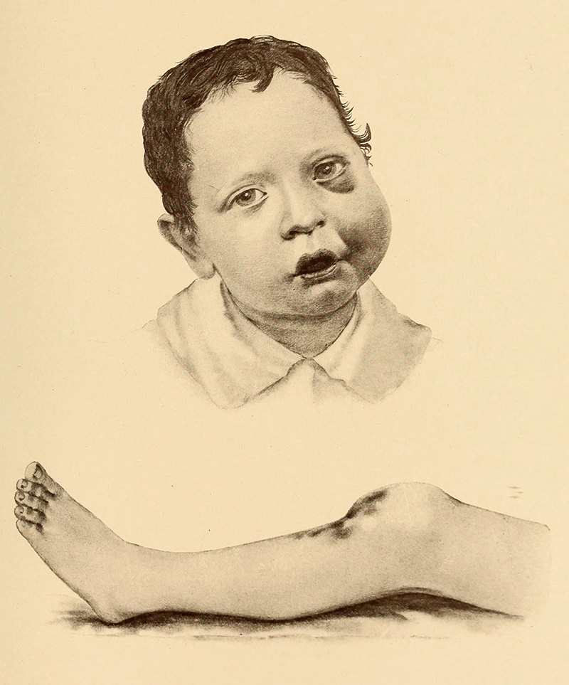 Chłopiec cierpiący na hemofilię. Grafika z podręcznika medycznego