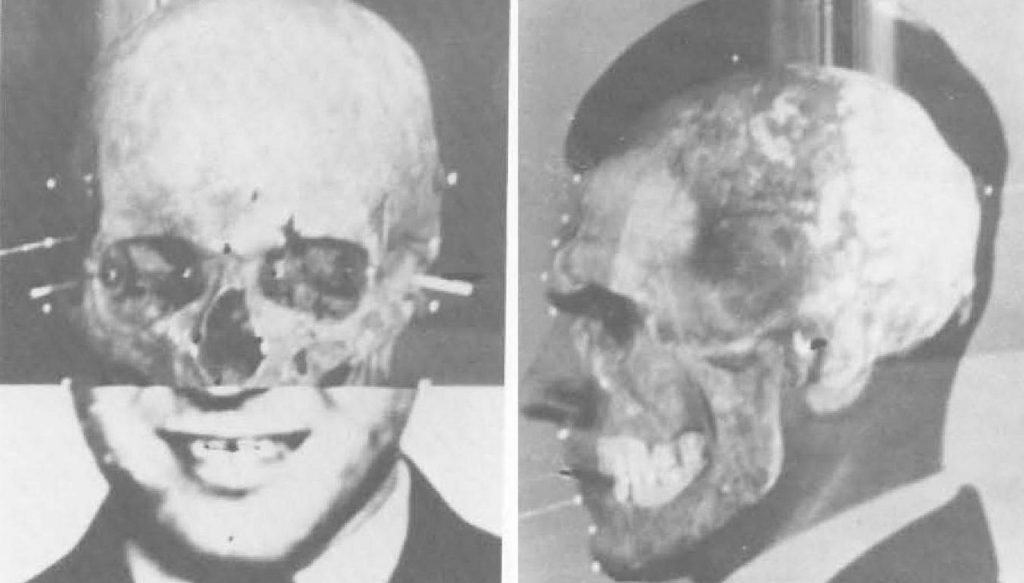 Jedną z metod wykorzystanych do potwierdzenia czy odnaleziony w Embu szkielet należał do Mengele było nałożenie czaszki na zdjęcie anioła śmierci (Richard Heimer/domena publiczna). 